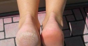 Zrogowaciała skóra stóp – prosty sposób na gładkie stopy