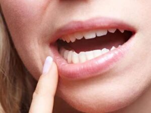 Brak witamin - objawy, które rozpoznasz w jamie ustnej