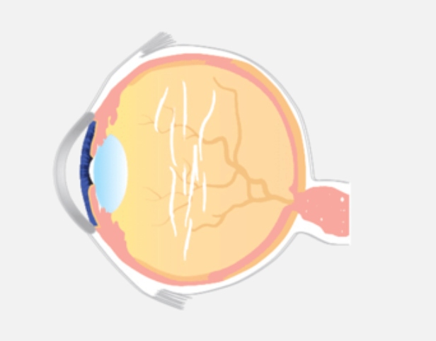 grudki kolagenu w ciele szklistym oka